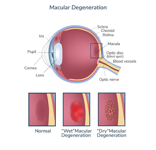 Macular Degeneration Diagram Macular Degeneration Diagram